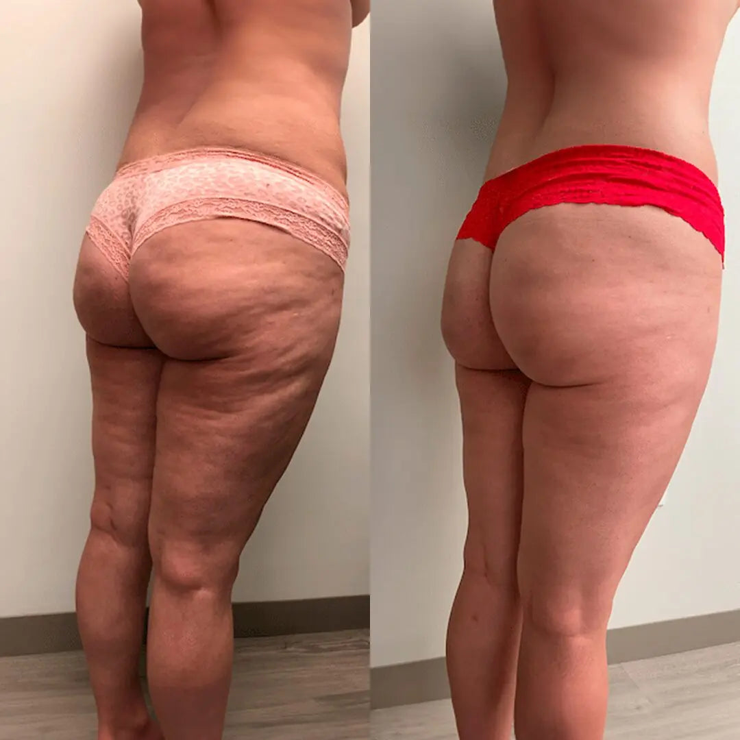 Side-by-side comparison: thighs